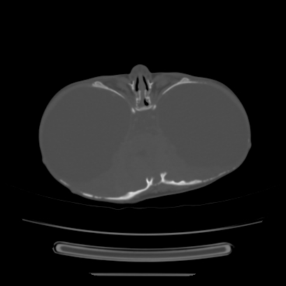 Cloverleaf skull (Radiopaedia 91901-109710 Axial bone window 65).jpg