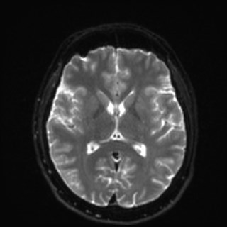 Cochlear incomplete partition type III associated with hypothalamic hamartoma (Radiopaedia 88756-105498 Axial DWI 22).jpg