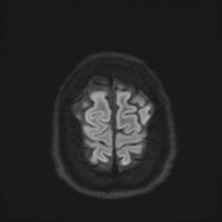 Cochlear incomplete partition type III associated with hypothalamic hamartoma (Radiopaedia 88756-105498 Axial DWI 78).jpg
