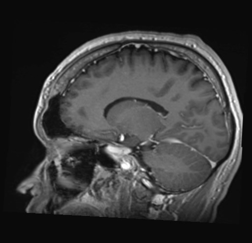 Cochlear incomplete partition type III associated with hypothalamic hamartoma (Radiopaedia 88756-105498 Sagittal T1 C+ 22).jpg