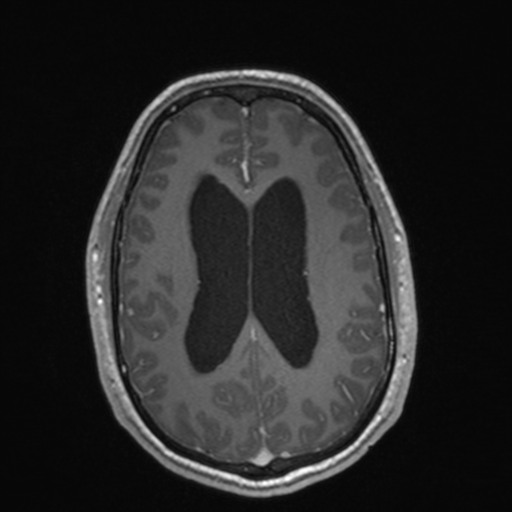 File:Colloid cyst (Radiopaedia 44510-48181 Axial T1 C+ 119).png