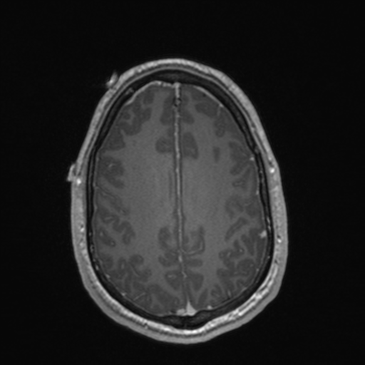 File:Colloid cyst (Radiopaedia 44510-48181 Axial T1 C+ 138).png