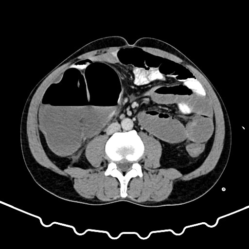 Colocolic intussusception due to large lipoma (Radiopaedia 68773-78482 A 102).jpg