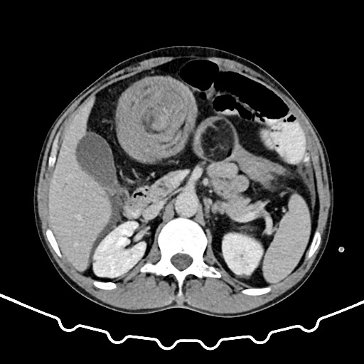 Colocolic intussusception due to large lipoma (Radiopaedia 68773-78482 A 58).jpg