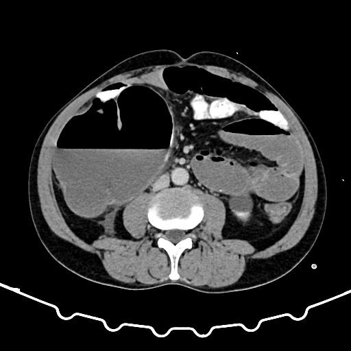 Colocolic intussusception due to large lipoma (Radiopaedia 68773-78482 A 98).jpg