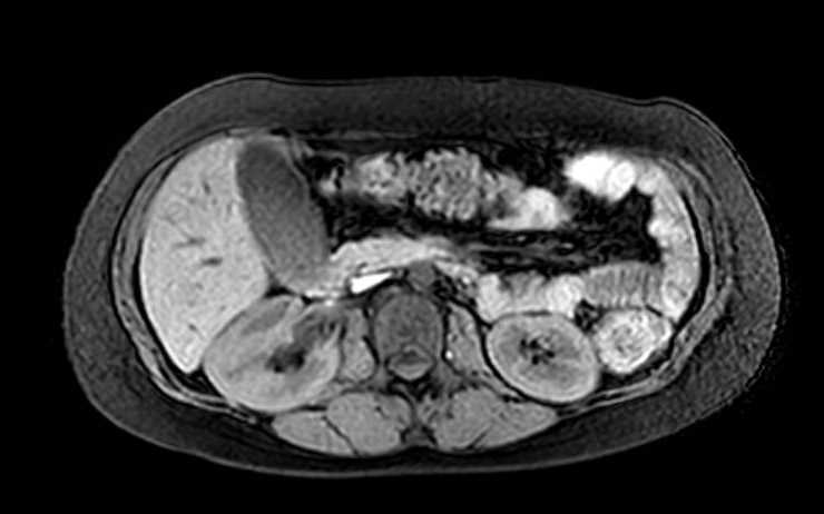 Colon adenocarcinoma with Krukenberg tumors, advanced pregnancy (Radiopaedia 67279-76645 A 52).jpg