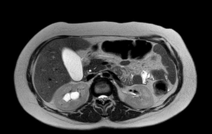 Colon adenocarcinoma with Krukenberg tumors, advanced pregnancy (Radiopaedia 67279-76645 Axial T2 55).jpg