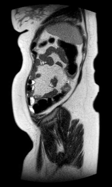 Colon adenocarcinoma with Krukenberg tumors, advanced pregnancy (Radiopaedia 67279-76645 Sagittal T2 8).jpg