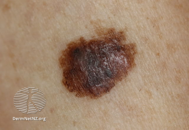 File:Large melanoma in situ (DermNet NZ 0230-MiS-macro-v2).jpg