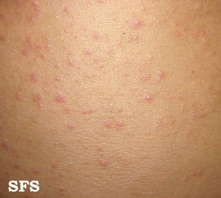 File:Miliaria (Dermatology Atlas 2).jpg