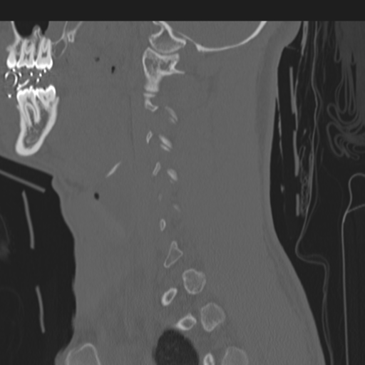 File:Multitrauma with diffuse axonal injury, temporal bone fractures and traumatic caroticocavernous fistula (Radiopaedia 37242-39035 Sagittal 35).png