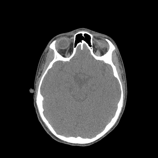 Nasal pyogenic granuloma (lobular capillary hemangioma) (Radiopaedia 85536-101244 Axial non-contrast 113).jpg
