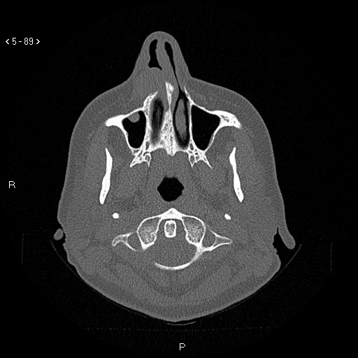 File:Nasolabial cyst (Radiopaedia 75125-86194 Axial bone window 50).jpg