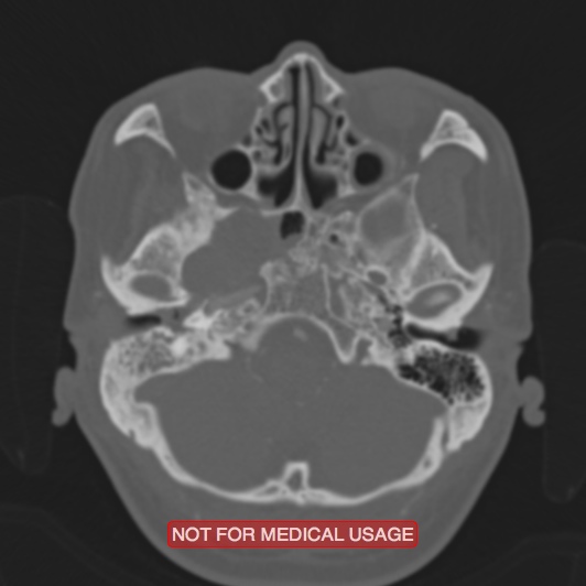 File:Nasopharyngeal carcinoma recurrence - skull base destruction (Radiopaedia 29107-29490 Axial bone window 86).jpg
