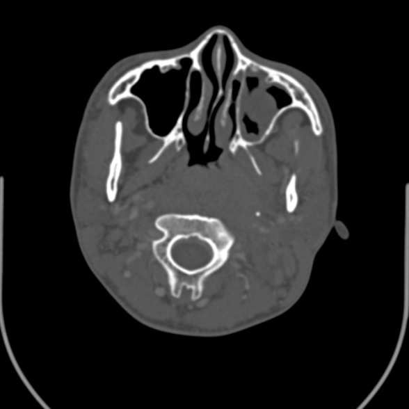 Nasopharyngeal carcinoma with skull base invasion (Radiopaedia 53415-59705 Axial bone window 60).jpg