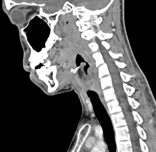 Nasopharyngeal carcinoma with skull base invasion (Radiopaedia 53415-59705 C 29).jpg