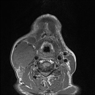 Nasopharyngeal carcinoma with skull base invasion (Radiopaedia 59258-66600 B 50).jpg
