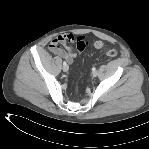 File:Necrotizing pancreatitis with acute necrotic collections (Radiopaedia 38829-41012 B 68).png