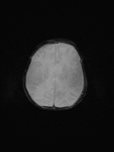 File:Neonatal hypoxic-ischemic encephalopathy (Radiopaedia 41406-44277 Axial Gradient Echo 8).jpg