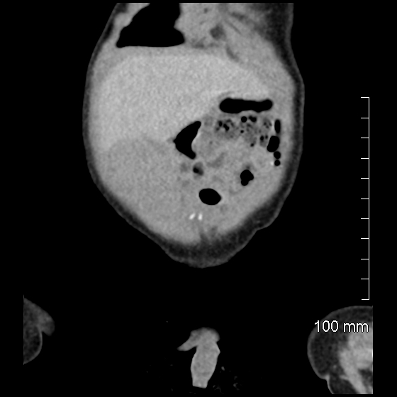 File:Neonatal neuroblastoma (Radiopaedia 56651-63438 Coronal non-contrast 9).jpg