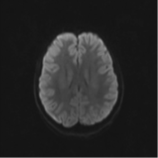 Neurenteric cyst (Radiopaedia 58641-65837 Axial DWI 58).png