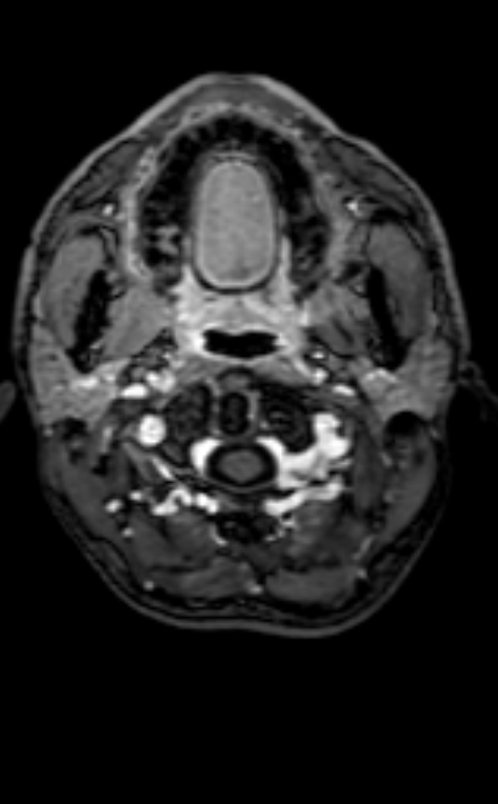 Neuro-Behçet disease (Radiopaedia 90112-107294 Axial T1 C+ 209).jpg