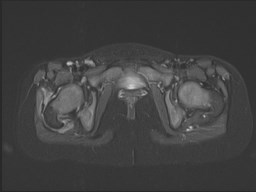 File:Neuroblastoma with bone metastases (Radiopaedia 67080-76414 Axial STIR 46).jpg