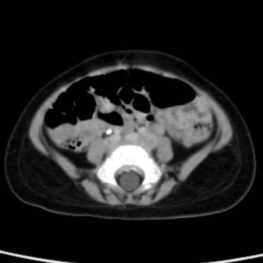 Neuroblastoma with skull metastases (Radiopaedia 30326-30960 C 41).jpg