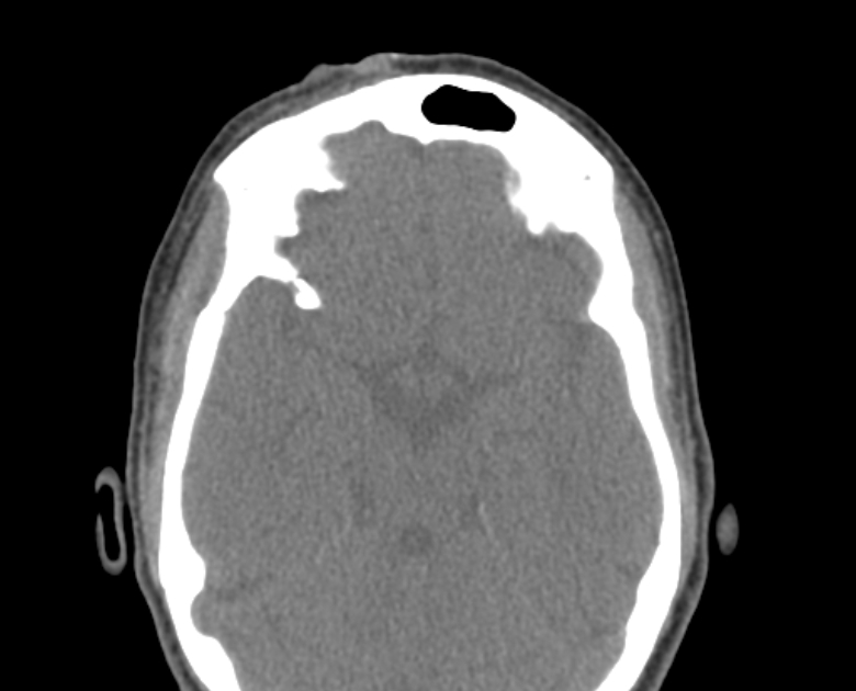 Neurofibromatosis type 1- orbital manifestations (Radiopaedia 49391-54511 Axial non-contrast 64).jpg
