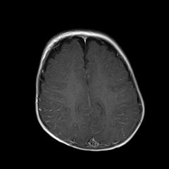 File:Neurofibromatosis type 1 (Radiopaedia 30089-30671 Axial T1 C+ 17).jpg