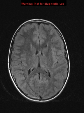 File:Neurofibromatosis type 1 with optic nerve glioma (Radiopaedia 16288-15965 Axial FLAIR 11).jpg