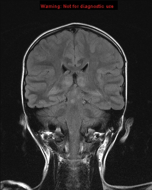 File:Neurofibromatosis type 1 with optic nerve glioma (Radiopaedia 16288-15965 Coronal FLAIR 10).jpg
