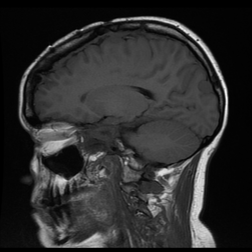 File:Neurofibromatosis type 2 (Radiopaedia 45229-49251 Sagittal T1 8).png