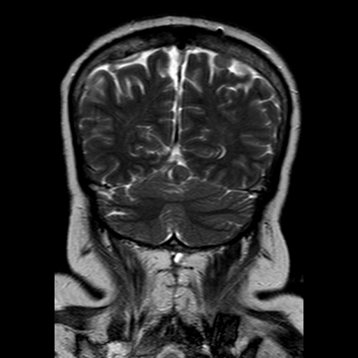File:Neurofibromatosis type 2 (Radiopaedia 8713-9518 Coronal T2 20).jpg