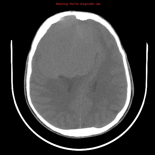 File:Neurofibromatosis type 2 (Radiopaedia 8953-9732 Axial non-contrast 23).jpg