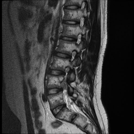 File:Neurofibromatosis type 2 (spinal manifestations) (Radiopaedia 53943-60070 E 10).png