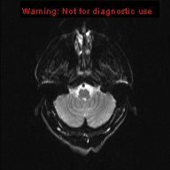 File:Neuroglial cyst (Radiopaedia 10713-11184 Axial DWI 19).jpg
