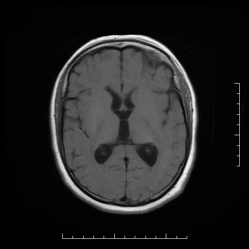 File:Neuroglial cyst of brainstem (Radiopaedia 29134-29526 Axial T1 11).jpg