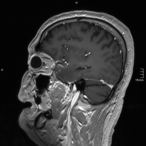 Neurosarcoidosis - involvement of the mesial temporal lobes (Radiopaedia 67429-76820 Sagittal T1 C+ 51).jpg
