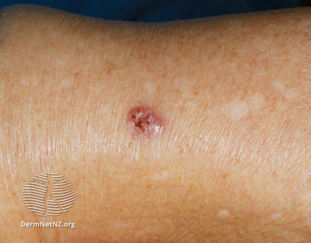 File:Nodular basal cell carcinoma, arm (DermNet NZ nbcc-arm-29-dn).jpg