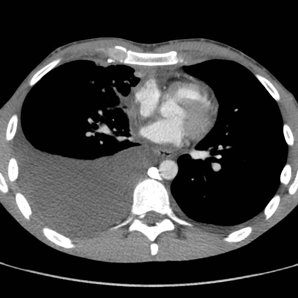 File:Non-Hodgkin lymphoma involving lung (Radiopaedia 29094-29470 B 41).jpg