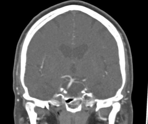 File:Normal CTA head (Radiopaedia 40801-43464 B 50).png
