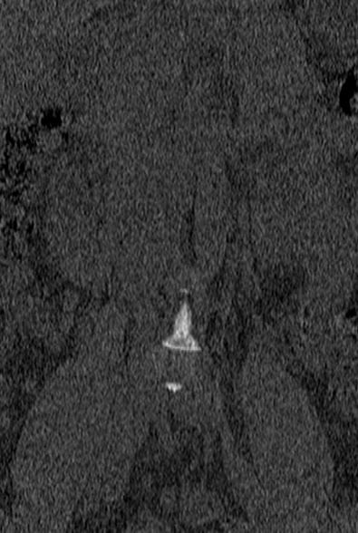 Normal CT lumbar spine (Radiopaedia 53981-60118 Coronal bone window 1).jpg