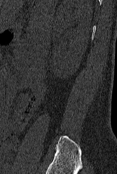File:Normal CT lumbar spine (Radiopaedia 53981-60118 Sagittal bone window 94).jpg