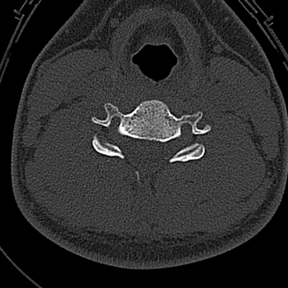 Normal CT of the cervical spine (Radiopaedia 53322-59305 Axial bone window 160).jpg