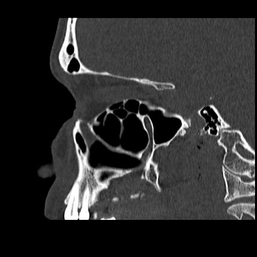 Normal CT paranasal sinuses (Radiopaedia 42286-45390 Sagittal bone window 35).jpg