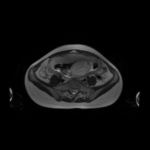 File:Normal MRI abdomen in pregnancy (Radiopaedia 88001-104541 Axial T2 48).jpg