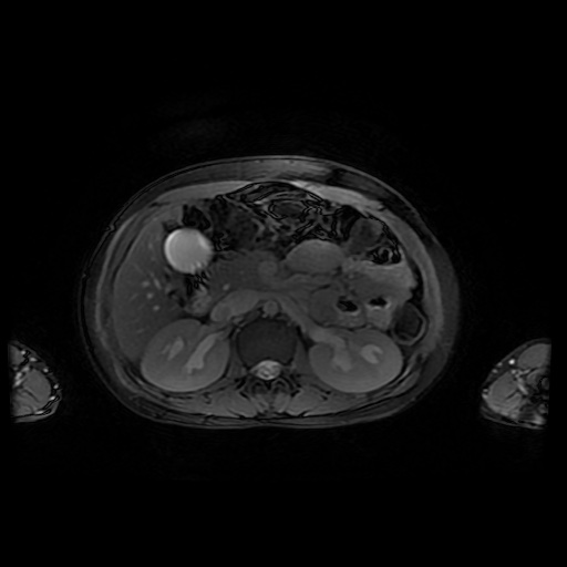File:Normal MRI abdomen in pregnancy (Radiopaedia 88001-104541 D 19).jpg