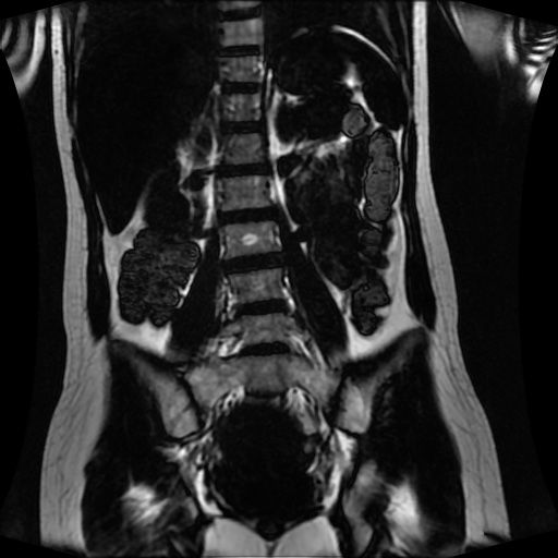 Normal MRI abdomen in pregnancy (Radiopaedia 88001-104541 N 88).jpg