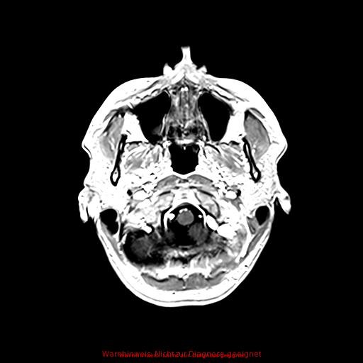 Normal adult brain MRI (non-enhanced and contrast-enhanced) (Radiopaedia 75262-86379 Axial T1 C+ 42).jpg